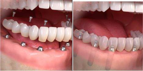 Alle tanden vervangen Centrum Kaak- & Aangezichtschirurgie